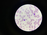 I took a picture from a light microscope in the institute of endemic diseases in Khartoum. Try to find a leishmania amastigote.