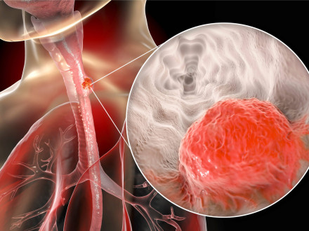 Nádor na jícnu - ilustrační grafika