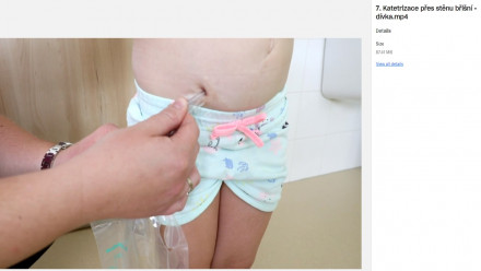 Katatrizace přes břišní stěnu Katatrizace přes břišní stěnu